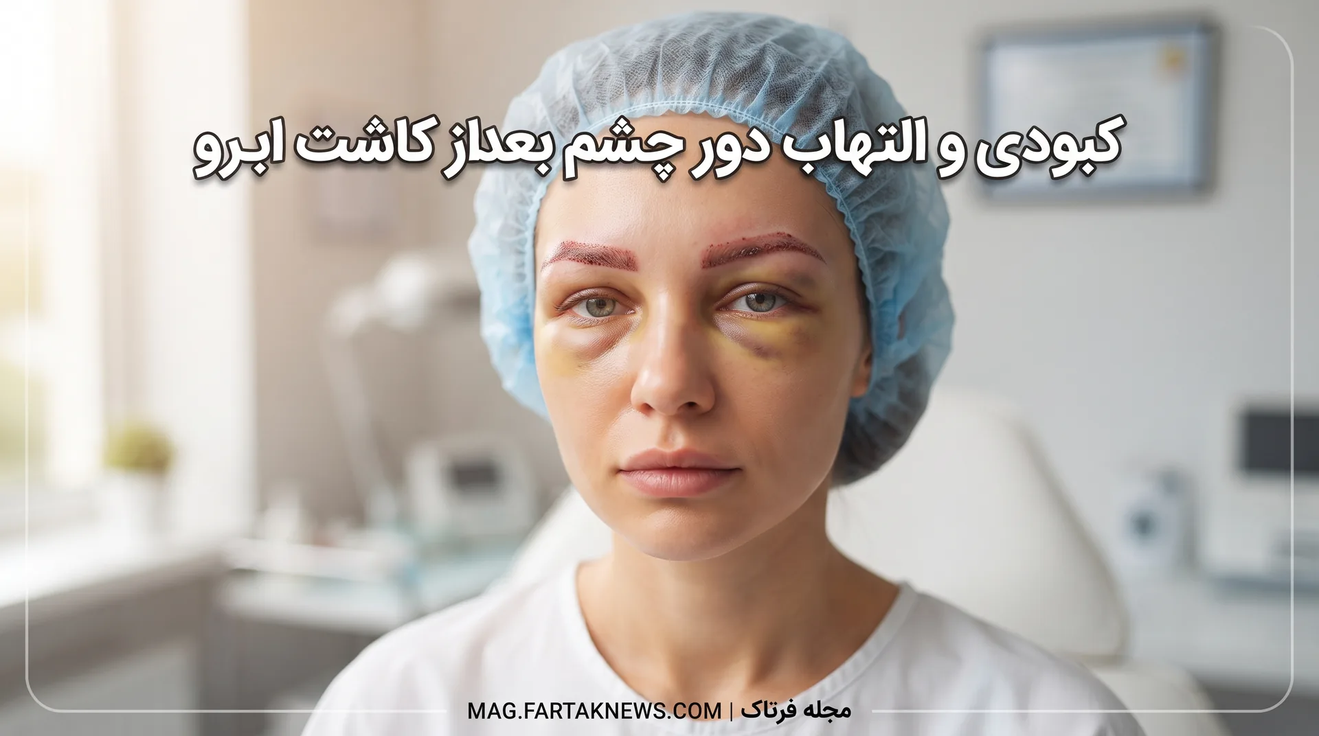 کبودی و التهاب دور چشم بعد از کاشت ابرو
